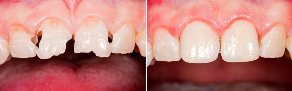 Реставрация переднего зуба в томске кариес сколько развивается